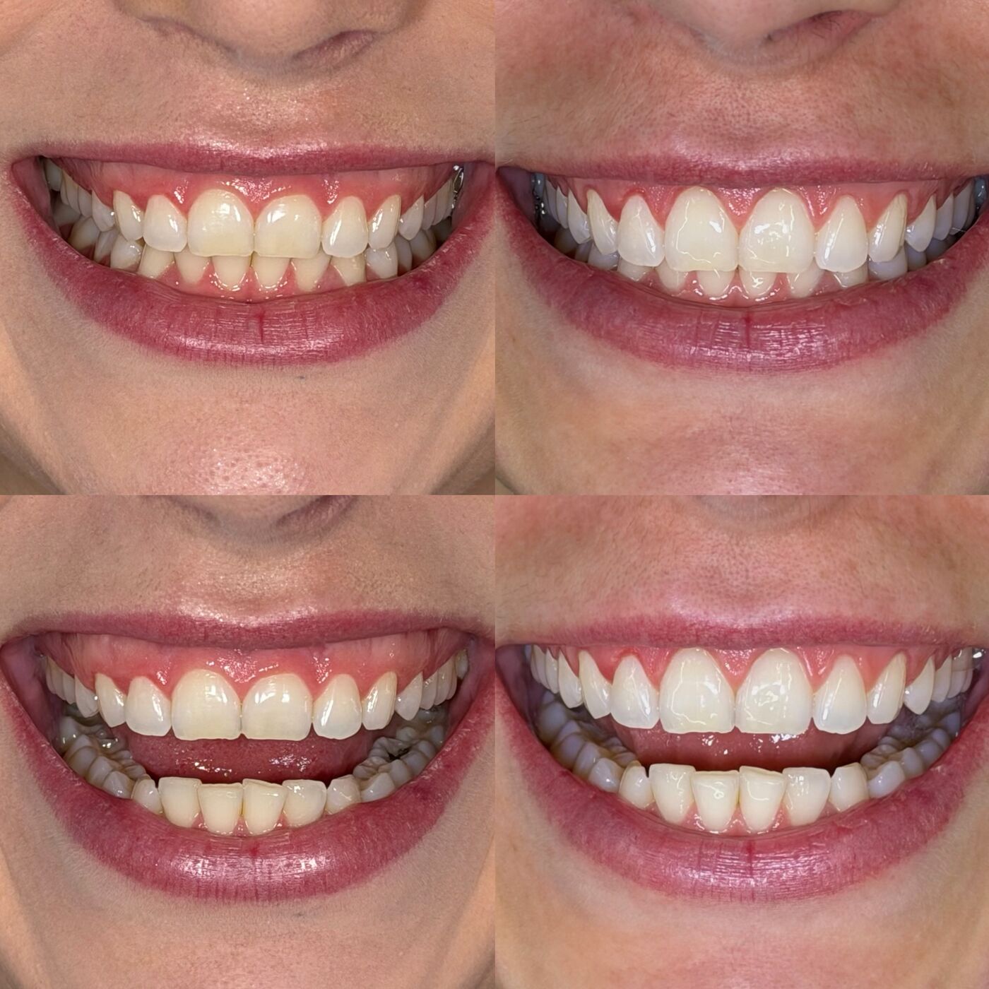 Antes e depois de um tratamento estético feito pela Dra. Karla Koene